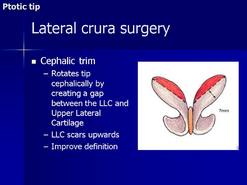 Lateral crura surgery Cephalic trim Rotates tip cephalically by creating a gap between the